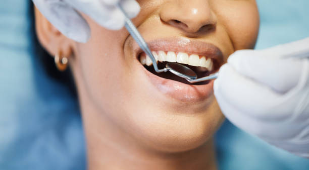 Best Knocked-Out Tooth (Avulsed Tooth) Treatment in Fort Loramie, OH